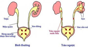 Dị tật bẩm sinh hệ tiết niệu