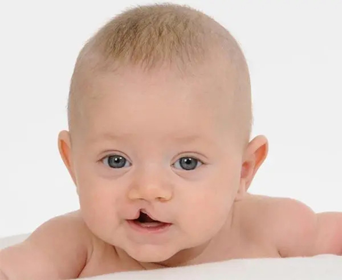 Dị tật sứt môi, hở hàm ếch