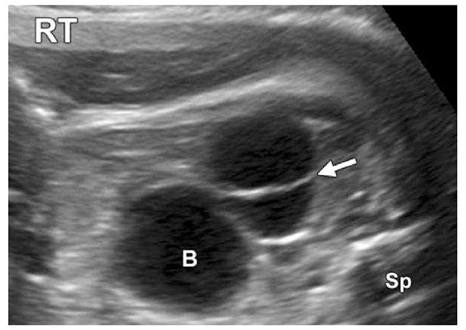 Hình ảnh nang buồng trứng xuất hiện trong quý 3 ở thai trẻ gái