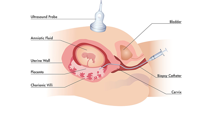 Sinh thiết nhau thai bằng một catheter mềm đi đường âm đạo