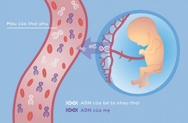 Sàng lọc trước sinh không xâm lấn - Hiểu đúng để chọn đúng