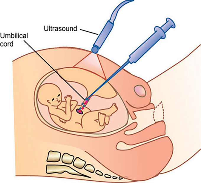 Các xét nghiệm chẩn đoán được thực hiện khi NPIT cho kết quả bất thường