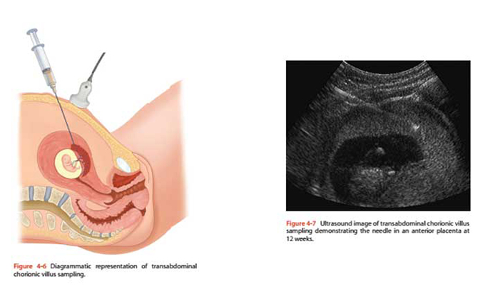 Sinh thiết gai nhau