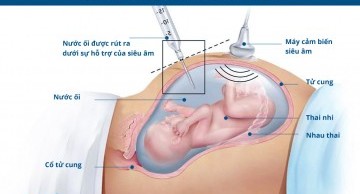 Chọc ối sàng lọc trước sinh