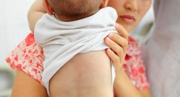 dị tật thai nhi mọc đuôi