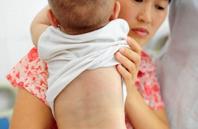 dị tật thai nhi mọc đuôi