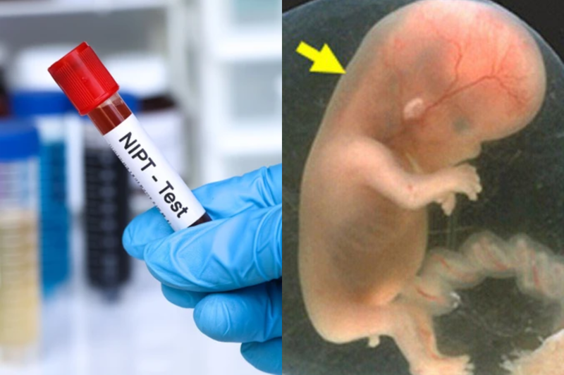 Mẹ bầu n&ecirc;n thực hiện kết hợp cả NIPT v&agrave; si&ecirc;u &acirc;m đo độ mờ da g&aacute;y&nbsp;