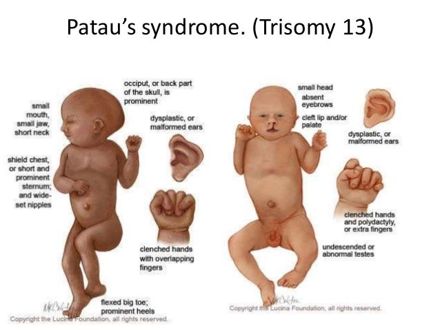 Nguyên nhân gây ra hội chứng Patau là gì?
