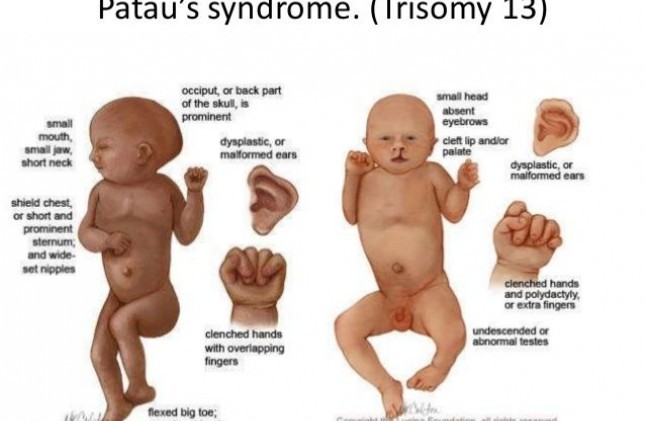 Hội chứng Patau là gì?